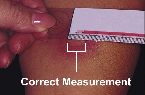 skin%20test%20measurement.jpg