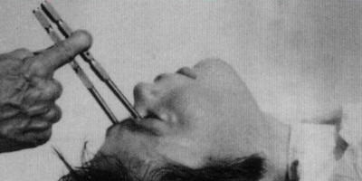 lobotomy1.jpg