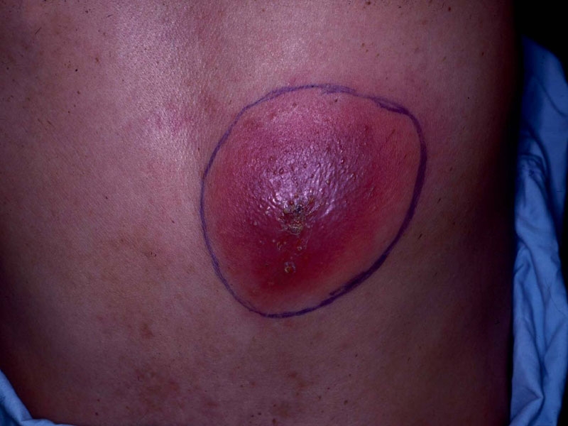 Abscess_zpsy1q39m1t.jpg