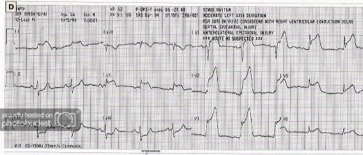 AnteriorSeptal.jpg