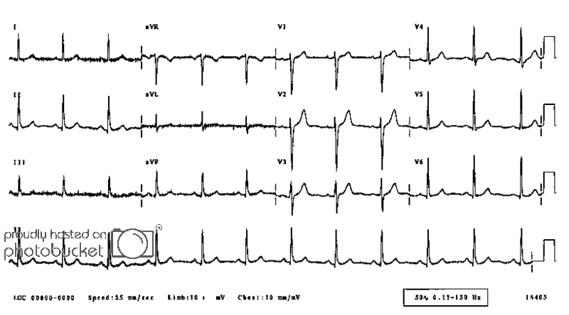 Normal12Lead.gif