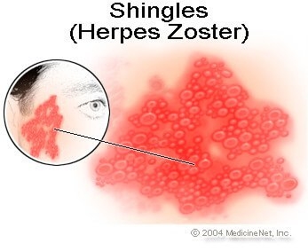 shingles.jpg