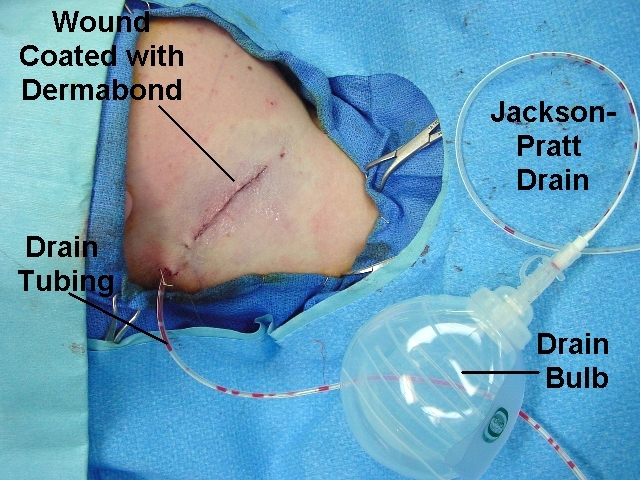 Branchial_Cleft_Cyst_Incision_JP_Drain.jpg