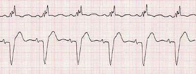 lbbb.jpg