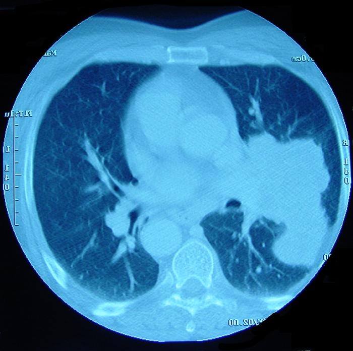 ct-scan-lung-cancer-3.jpg