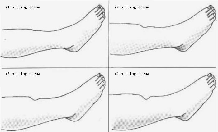 pitting-edema-examples.jpg.3dfdc76513c89ff6711877abd5716f78.jpg
