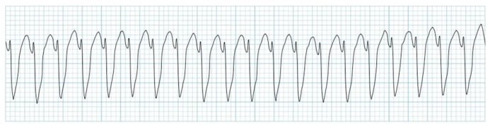 EKG strip