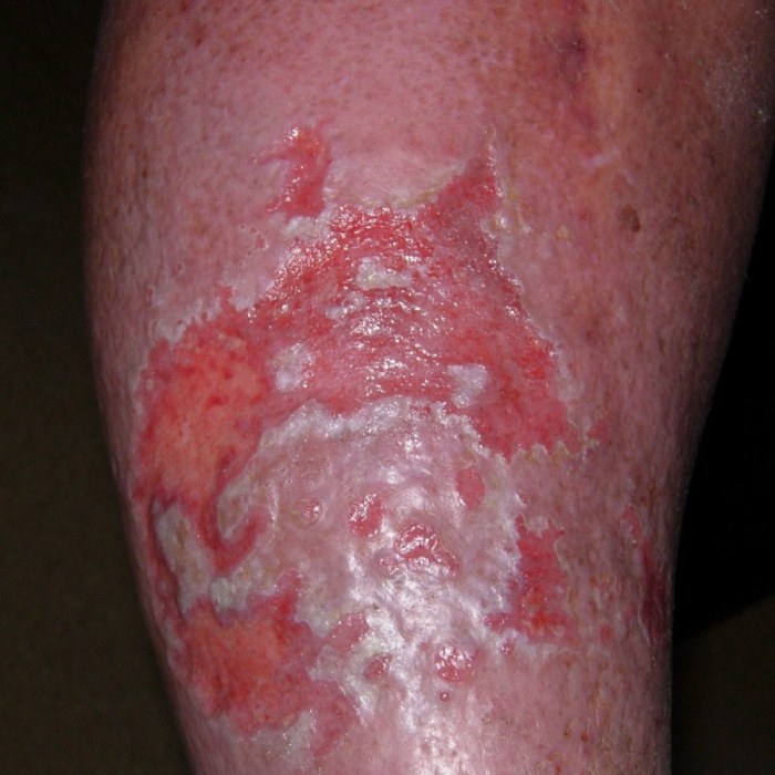 Risk of bacteria infection