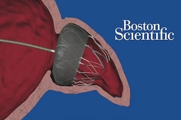 Atrial Fibrillation, Strokes and the WATCHMAN Implant