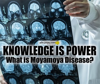 Moyamoya Disease | Knowledge Brush-Up