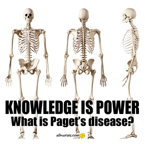 Paget's  Disease of Bone | Knowledge Brush-Up
